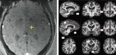 Une nouvelle technique au Queen Square Imaging Centre améliore le traitement du tremblement essentiel.