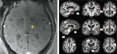 Une nouvelle technique au Queen Square Imaging Centre améliore le traitement du tremblement essentiel.
